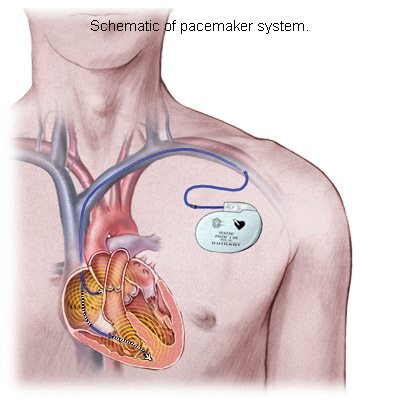 “Exploring the Heart’s Rhythm: Can a Pacemaker for Bradycardia ...